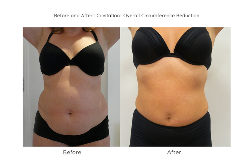 3d cavitation at synergy beauty salon in studley