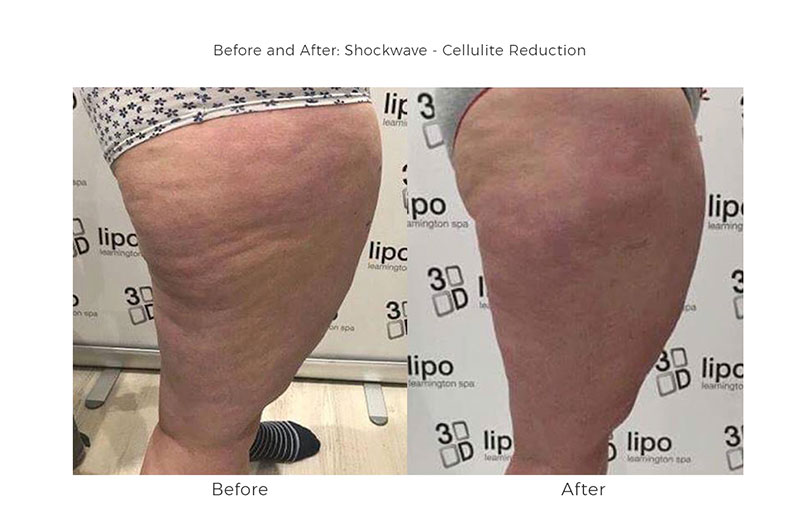 3D Lipo at Synergy Beauty Redditch 3D Lipo at Synergy Beauty Redditch