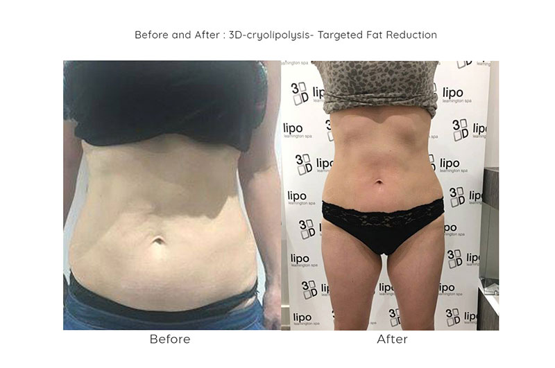 NON SURGICAL LIPOSUCTION AT SYNERGY HAIR SALON IN STUDLEY WARWICKSHIRE NON SURGICAL LIPOSUCTION AT SYNERGY HAIR SALON IN STUDLEY WARWICKSHIRE
