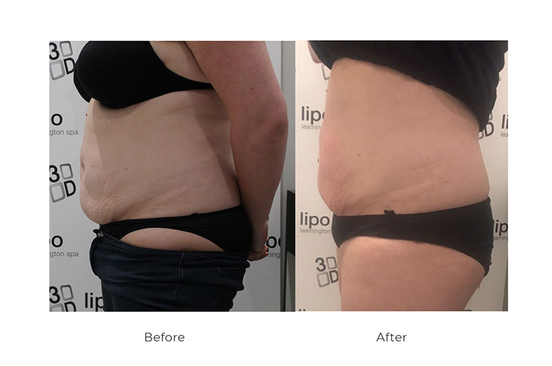 3d skin tightening at synergy beauty salon Warwickshire 3d skin tightening at synergy beauty salon Warwickshire
